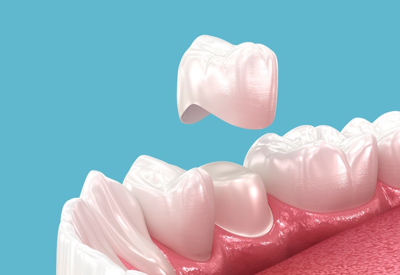 A 3D illustration of a dental crown being placed on a tooth in Monroeville, PA