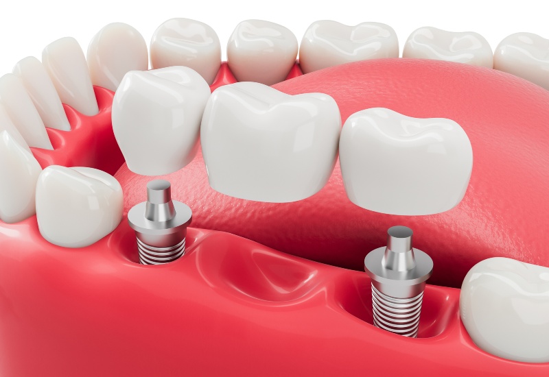Close-up of inflamed gums with lesions, highlighting bleeding gums issue in Monroeville, PA