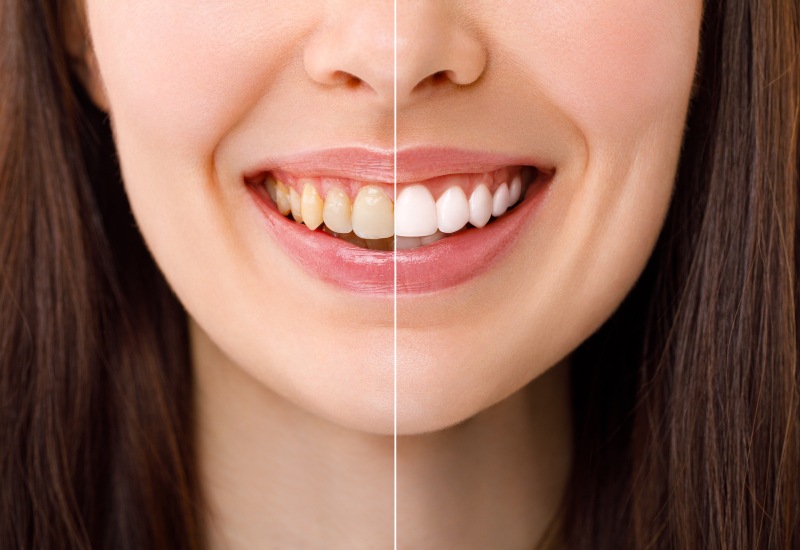 A close-up of whitening results shows sensitivity after teeth whitening in Monroeville, PA