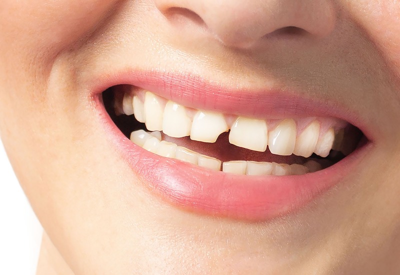 A close-up of chipped teeth, emphasizing dental treatment options to fix them in Monroeville, PA