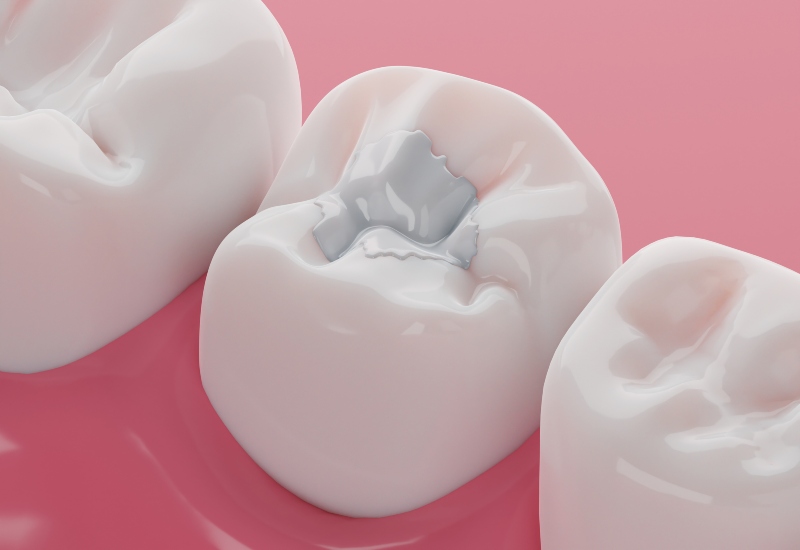 A close-up of a molar with a tooth-colored filling, showcasing dental care in Monroeville, PA